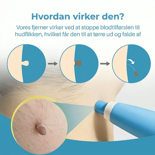 Hudfibromfjerner – Komplet sæt til sikker fjernelse af hudfibromer derhjemme