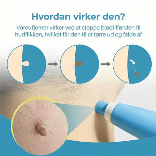 Infografik, der viser, hvordan hudlapfjerneren fungerer i tre trin – elastikken afskærer blodtilførslen, indtil hudlapperne tørrer ud og falder af af sig selv